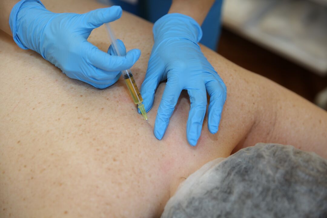 injekce chondroprotektorů pro záda