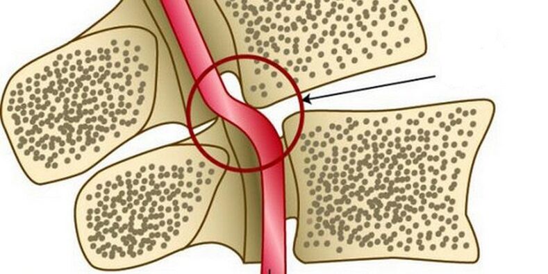 Deformace vertebrální tepny v důsledku nestability obratle